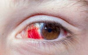 高山腦水腫症狀之眼睛充血