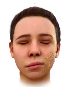 高山腦水腫併發症之腦中風-癥兆-臉部歪斜